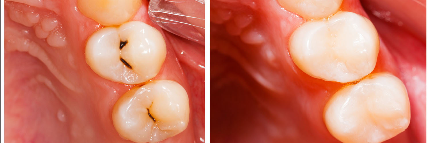 The image shows a close-up view of a dental implant with a gum line and a tooth with fillings, viewed from an angle that highlights its structure and color contrasts.