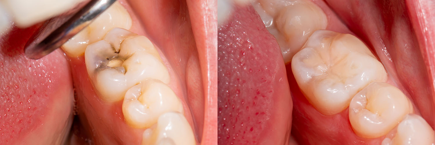 The image shows a close-up view of a dental implant with a metal screw partially exposed, surrounded by pink gum tissue and a tooth with decayed enamel.