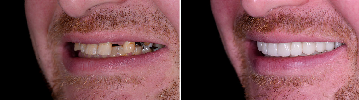 The image shows a split-screen comparison of a person s teeth before and after dental treatment, highlighting the transformation through cosmetic dentistry.